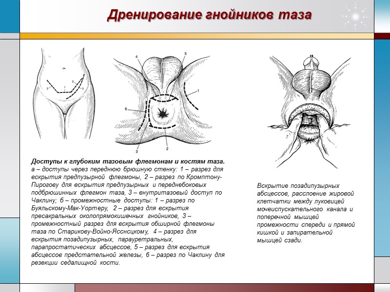 Дренирование гнойников таза Доступы к глубоким тазовым флегмонам и костям таза.  а –